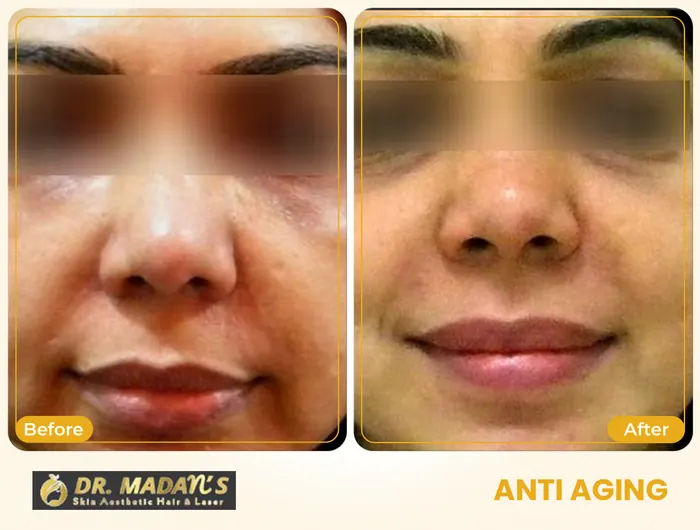 Anti aging before and after result 2 at Dr Madan Aesthetics